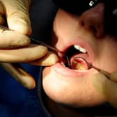 One in eight year 6 children in Ashfield reported having tooth decay last year