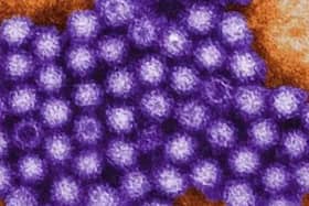 Cases of Norovirus are expected to rise
