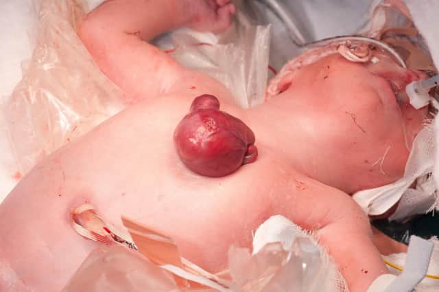 She beat eight-million-to-one odds after she became the first baby in Britain to survive the ultra-rare condition.